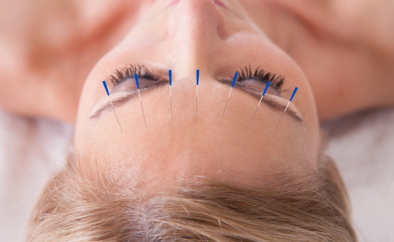 Skin-Care-Benefits-Acupuncture